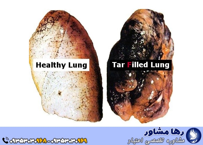 سرطان ریه از عوارض استعمال سیگار